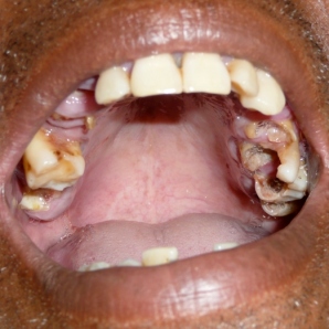 Typical dental condition in Timor